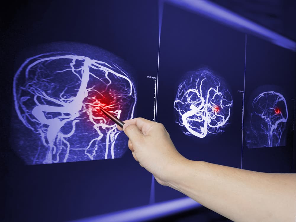 Close-up of a doctor pointing to an MRA brain scan image of a patient with a recent traumatic brain injury, showing brain contusion and hemorrhage.